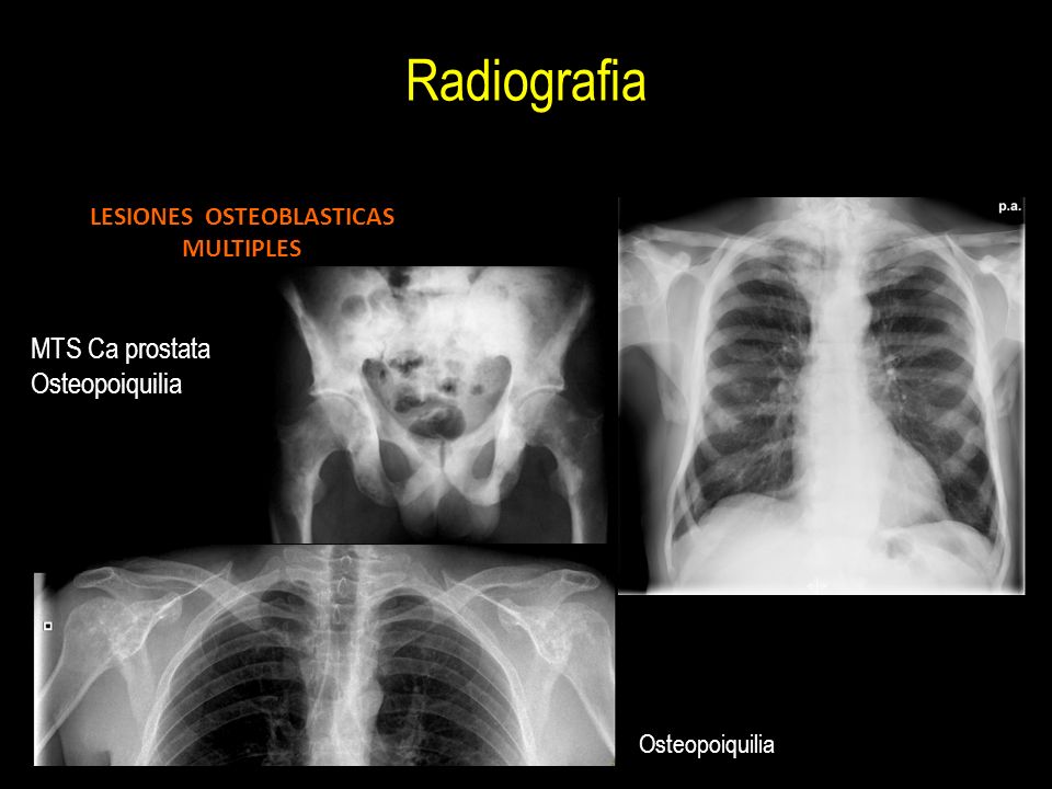 lesiones osteoblasticas en cancer de prostata lesiones osteoblasticas en cancer de prostata
